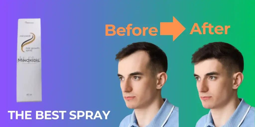 Minoxidil Spray for Hair